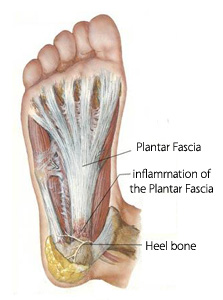 Steroid injection feet